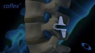 coflex® NonFusion Implant in Flexion and Extension  Paradigm Spine [upl. by Yadsnil]