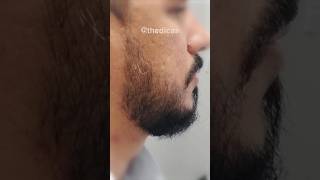 ANTES E DEPOIS MINOXIDIL 2 anos e 3 meses de tratamento minoxidil barba thedicas [upl. by Cowles]