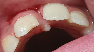 supernumerary tooth mesiodens  زوائد الاسنان [upl. by Keverian113]