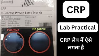 CRP Test Procedure in Hindi  CReactive Protein  Latex Test Procedure labtechnician mlt dmlt [upl. by Alikee520]