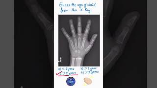 Radiology Quiz Age assessment from x ray hand Bone age from xray hand Anatomy puzzle shorts [upl. by Chouest]