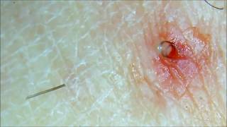 Long InGrOwN hAiR removed Check it out [upl. by Tillie]