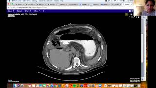 Complication after right hepatectomy Learn what a Kocher maneuver is Aarti Sekhar [upl. by Morgenthaler45]