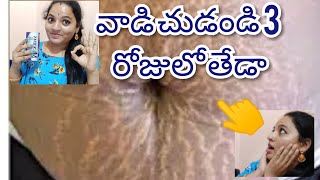 Remove stretch masks completely from all body parts  easy method in teluguవాడిచుడండి3రోజులో తేడా [upl. by Lorenzana]