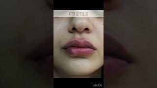 Lip Filler Before and After Compilation  LIP FILLER drjyotiguptadermatologist7266 Lip Injections [upl. by Paco]