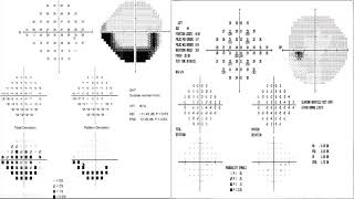 Perimetría Computarizada Parte IIDr Kobayashi [upl. by Aihsat]