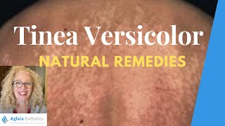 NATURAL HOME REMEDIES FOR TINEA VERSICOLOR [upl. by Yssis176]