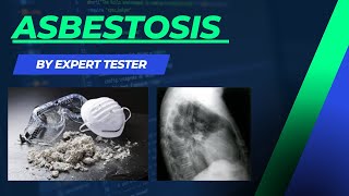 Asbestosis  Pneumoconiosis  Causes  Symptoms  Diagnosis  Treatment amp Pathology [upl. by Ahsenyt]