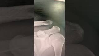 injury scootering mounthawkeskatepark2035 skatepark indoor subscribe [upl. by Aiouqahs]