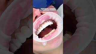 Temporary Veneers vs Porcelain Veneers  Cosmetique Dental [upl. by Rukna]