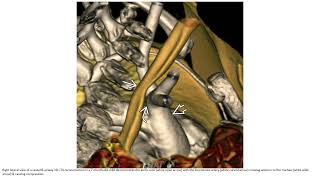 Innominate Artery Compression Syndrome Imaging [upl. by Oaks]