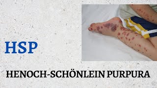 HenochSchönlein Purpura HSP [upl. by Odom970]