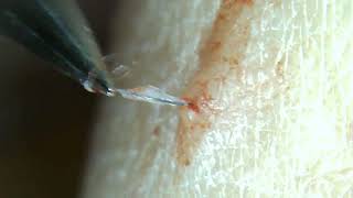 WARNING MAY BE TOO GRAPHIC Another gross JACKPOT Ingrown hair treasure [upl. by Aminta]