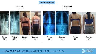 ApiFix Treatment for Scoliosis AISNonfusion technique combined with Scoliosis Specific Exercises [upl. by Fabien]