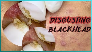 Big Cystic Acne Blackheads Extraction Blackheads amp Milia Whiteheads Removal Pimple Popping [upl. by Epperson876]