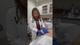 Stretch Mark removal treatment Morpheus8 Radiofrequency Microneedling stretchmarksremoval [upl. by Platt]