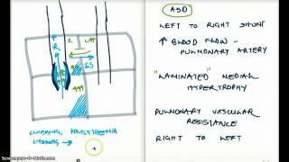 ASD Eisenmengers Syndrome Fixed Split and Surgery [upl. by Hortensa]