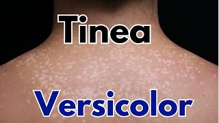 Tinea versicolor symptoms treatment  how to get rid of tinea versicolor [upl. by Kokaras607]