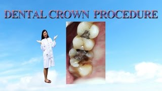 dental crown procedure [upl. by Najtsirk]