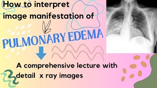 Pulmonary edema Xrays manifestation II How Edema fluid can be diagnosed on chest Xrays [upl. by Auahsoj]