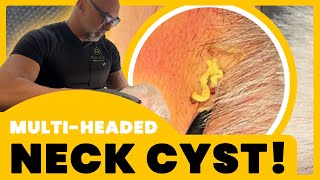 MULTIHEADED NECK CYST [upl. by Frisse]