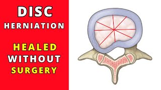 L5 S1 Disc Herniation Recovery without surgery [upl. by Anafetse]