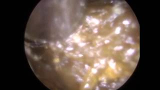 276  Ear Wax Removal with Jobson Horne and Suction revealing MIDDLE EAR EFFUSION [upl. by Eentruok]