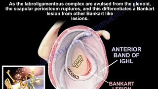 Lesions Of The Shoulder Bankart Lesion  Everything You Need To Know  Dr Nabil Ebraheim [upl. by Beau]