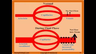 Acute Inflammation Vascular Permeability amp Vasodilation Fluid Phase Macrophage Neutrophil [upl. by Tennies434]