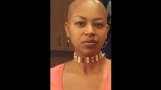 My Hair Journey with Scarring Alopecia [upl. by Jereld]