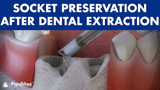 Tooth extraction  Treatment for socket preservation © [upl. by Ahsinna]