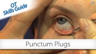 OT skills guide punctum plugs [upl. by Yvon113]