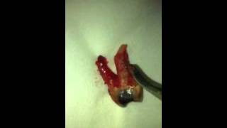 Dentist tooth extracted out [upl. by Idham722]