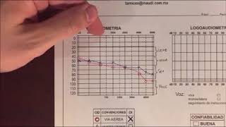 Video de como interpretar una audiometría [upl. by Hctud]