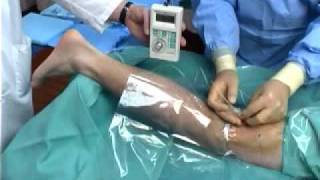 Continuous Popliteal Nerve Block [upl. by Deeann]