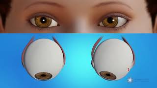 How is strabismus surgery done [upl. by Rannug514]