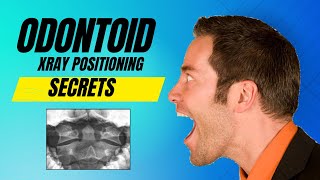 Secret To Odontoid Xray Positioning [upl. by Aerdied]