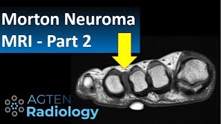 MRI of Morton Neuroma  part 2 [upl. by Jonathon]