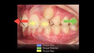 Tratamiento de un Canino Vestibular Impactado Colmillo Alto [upl. by Hardwick]