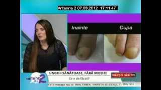 Tratamentul Onicomicozei Micoza Unghiei cu LaserulFormatk  Traieste sanatos Antena 2 [upl. by Ennaid756]