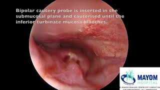 Turbinate Hypertrophy  Submucosal Diathermy Reduction by Dr Manish Prakash Mayom Hospital Gurgaon [upl. by Porett]