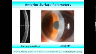 management of keratoconus part 3 [upl. by Nylasor]