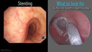 Mastering Bronchoscopy for Thoracic Surgery Chapter 3 [upl. by Tannie695]