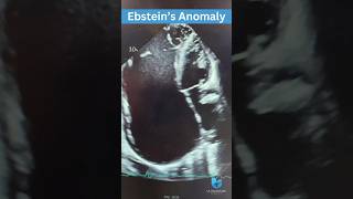 Ebstein’s Anomaly Echocardiogram [upl. by Namyh947]