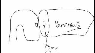 Whipple Procedure Pancreatic Anastomotic Techniques Part  1 [upl. by Wichern681]