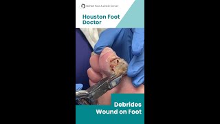 Wound Debridement by Houston Foot Doctor woundcare podiatrist footdoctor [upl. by Bonar]