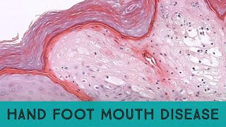 Hand foot and mouth disease HFMD Coxsackievirus pathology dermpath dermatology dermatopathology [upl. by Haseefan]