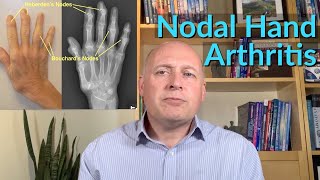 Hand amp Finger Arthritis  The Very Best SelfHelp Ideas [upl. by Latisha949]