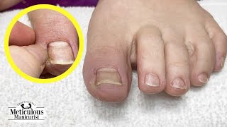 Ingrown Toenail Recovery and Prevention [upl. by Reehsab]