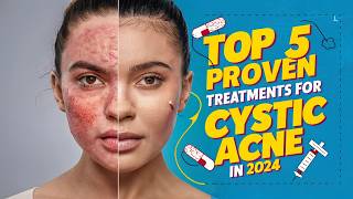 Top 5 Proven Treatments for Cystic Acne in 2024 Clear Skin Solutions [upl. by Siravart]